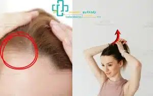 ریزش مو بعد از زایمان و آسیب مو در اثر بستن محکم مو