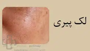 لک پیری (age spot)/ لک قهوه ای پوست