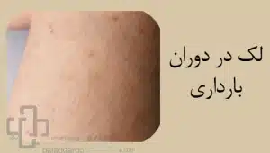 لک ناشی از اختلالات هورمونی؛ لک دوران بارداری/لک قهوه ای پوست