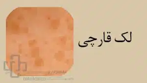 لک قهوه ای قارچی/ لک قهوه ای پوست