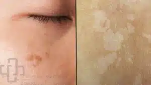 انواع لک پوستی صورت و بدن؛ لک سفید پوست (hypopigmentation) و لک قهوه ای پوست (hyperpigmentation)