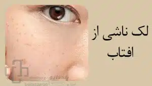 لک قهوه ای ناشی از آفتاب (sun spot)/ لک قهوه ای پوست