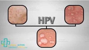 شکل زگیل تناسلی