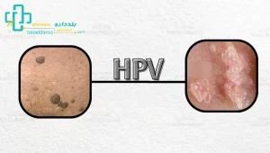 شکل اچ پی وی